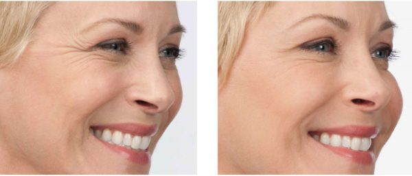 Botox Before/After Joplin, MO Botox Before/After Joplin, MO