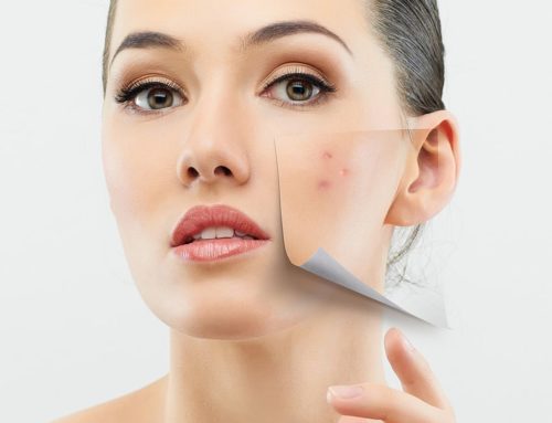 How Can I Reduce Pitted Acne Scars?