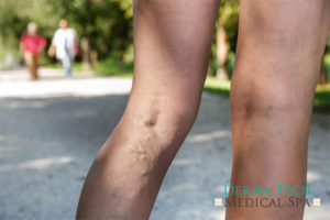 Spider-Vein-Removal_blog spider-vein-removal_joplin-mo