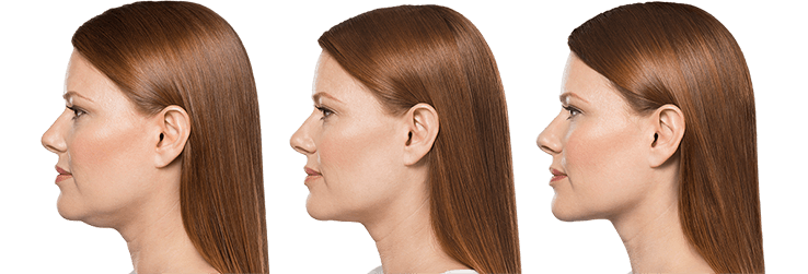 Kybella Joplin, MO Kybella Joplin, MO