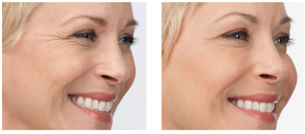 botox botox
