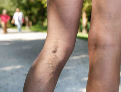 Am I a Candidate for Sclerotherapy?