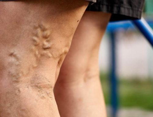 How Can I Get Rid of Spider Veins?